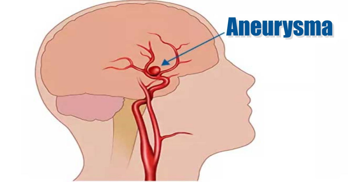 Co způsobuje aneurysma?